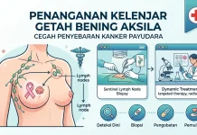 Penanganan Kelenjar Getah Bening Aksila Cegah Penyebaran Kanker Payudara