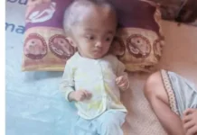 Maria, Anak Penderita Hidrosefalus di Manggarai Timur Butuh Biaya Pengobatan