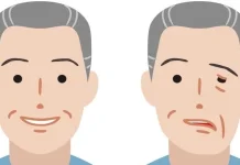 Kenali Gejala Stroke dengan SEGERA KE RS, Jangan Tunggu Sampai Terlambat