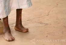 Health Minister Calls for Accelerated Leprosy Screening to Reduce Cases