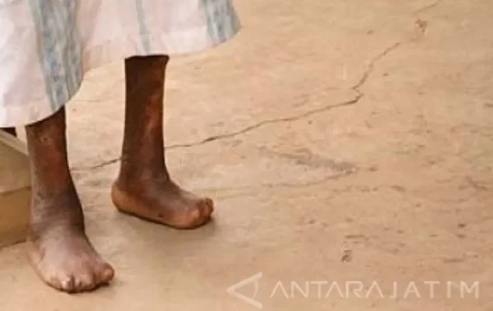 Health Minister Calls for Accelerated Leprosy Screening to Reduce Cases