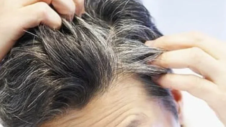 Trik Mengatasi Uban Rambut di Usia Muda