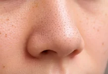 Kandungan Skincare Ampuh untuk Mengatasi Pori-Pori Besar dan Komedo