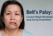 Bell’s Palsy Lumpuh Wajah Mendadak yang Sering Disepelekan