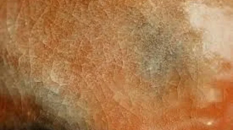 Psoriasis: Pengertian, Gejala, Penyebab, dan Penanganan