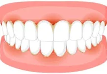 Tips Merawat Gigi dan Gusi agar Tetap Sehat dan Bersih