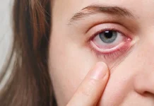 Sakit Mata Merah Menular dari Tatapan, Mitos atau Fakta?
