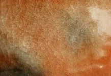 Psoriasis: Pengertian, Gejala, Penyebab, dan Penanganan