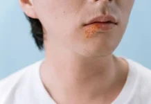 Ketahui Penyebab, Gejala, dan Cara Atasi Bibir Pecah-Pecah
