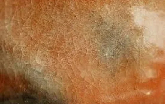 Psoriasis: Pengertian, Gejala, Penyebab, dan Penanganan