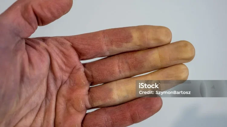 Sindrom Raynaud: Dingin Picu Gangguan Aliran Darah