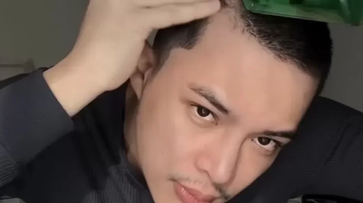 Rey Mbayang Ungkap Psoriasis, Kenali Penyebab dan Gejalanya