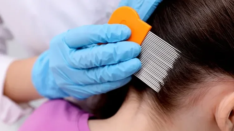 Ini Cara Efektif Menghilangkan Kutu Rambut Anak