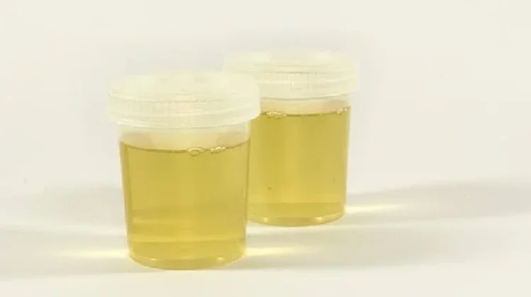Warna Urine dan Artinya yang Perlu Diketahui,