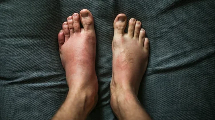 Kaki Tiba-Tiba Bengkak? Ini Bukan Selalu karena Kelelahan