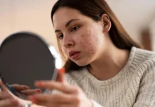 Tips Menghilangkan Noda Hitam Bekas Jerawat