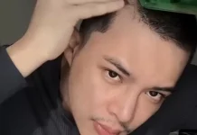 Rey Mbayang Ungkap Psoriasis, Kenali Penyebab dan Gejalanya