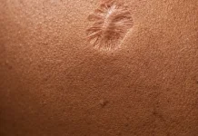 Bekas Vaksin Cacar, Tanda Tubuh Pernah Melawan Infeksi