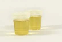 Warna Urine dan Artinya yang Perlu Diketahui,