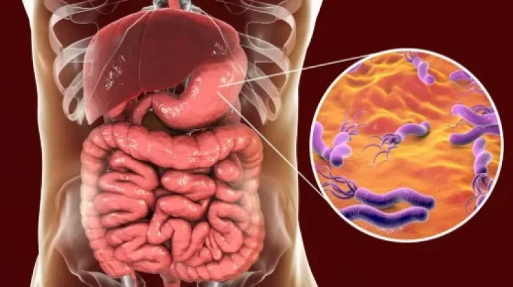 Bakteri Helicobacter Pylori, Salah Satu Penyebab Sakit Maag