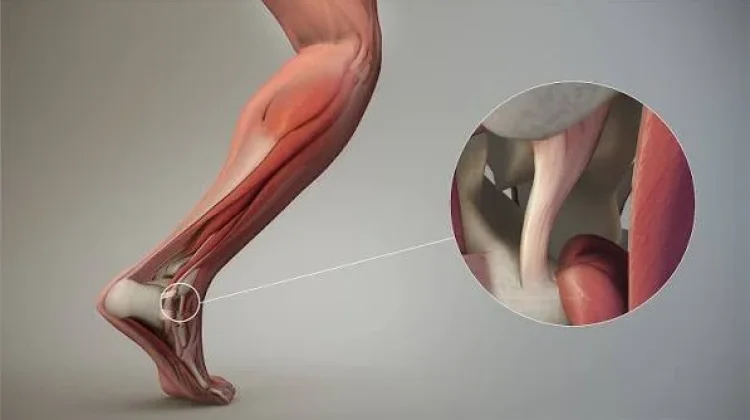 Mengenal Apa yang Namanya Cedera Ligamen