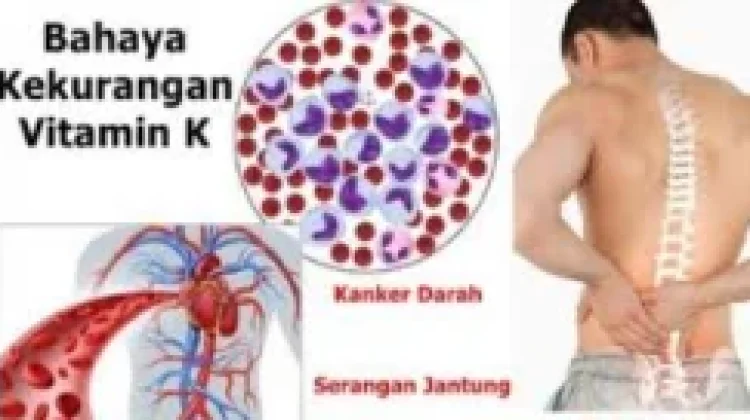 Berikut ini Kondisi Kesehatan Tubuh ketika Kekurangan Vitamin K