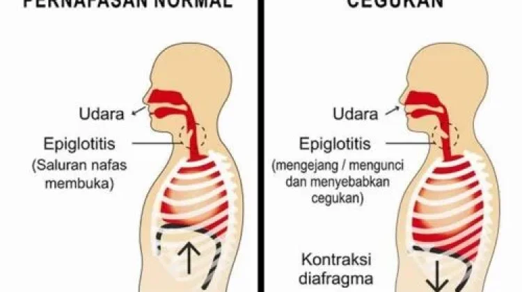 Cara Menghilangkan Cegukan yang Praktis untuk Dicoba