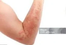 Apakah Anak Alergi Bisa Sembuh