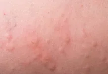 Penyebab Bentol di Kulit