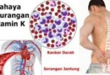 Berikut ini Kondisi Kesehatan Tubuh ketika Kekurangan Vitamin K