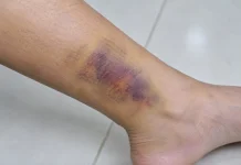 Lebam Muncul Ditubuh setelah Bangun Tidur, Apa Penyebabnya?