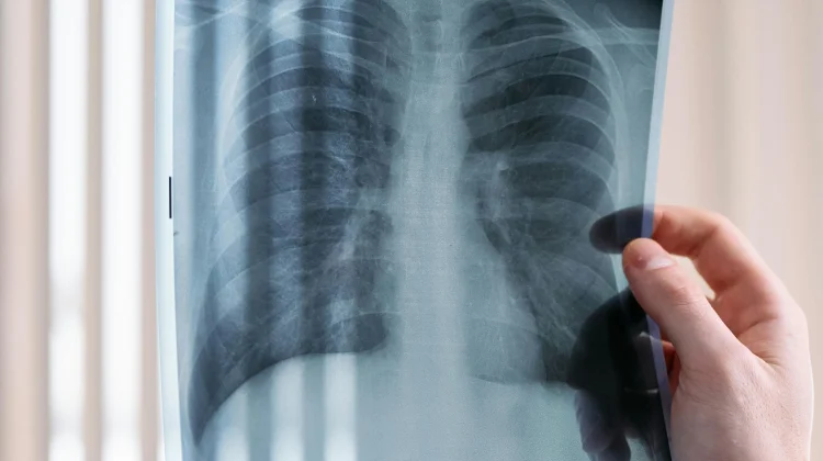 TB Mudah Menular Lewat Udara, Ventilasi Rumah Jadi Faktor Penting