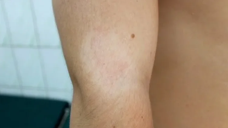 Bukan Panu, Kenali Pitiriasis Alba dan Ciri-cirinya