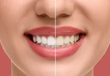 Tips Memutihkan Gigi Secara Alami dan Aman