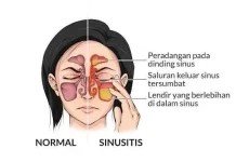 Sinusitis Menjadi Beberapa Alasan Orang Menjalani Operasi Hidung