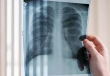 TB Mudah Menular Lewat Udara, Ventilasi Rumah Jadi Faktor Penting