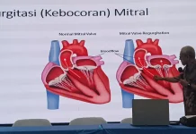 Primaya Hospital Hadirkan MitraClip untuk Atasi Kebocoran Katup Jantung