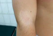 Bukan Panu, Kenali Pitiriasis Alba dan Ciri-cirinya