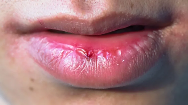 Tips Melembapkan Bibir saat Berpuasa