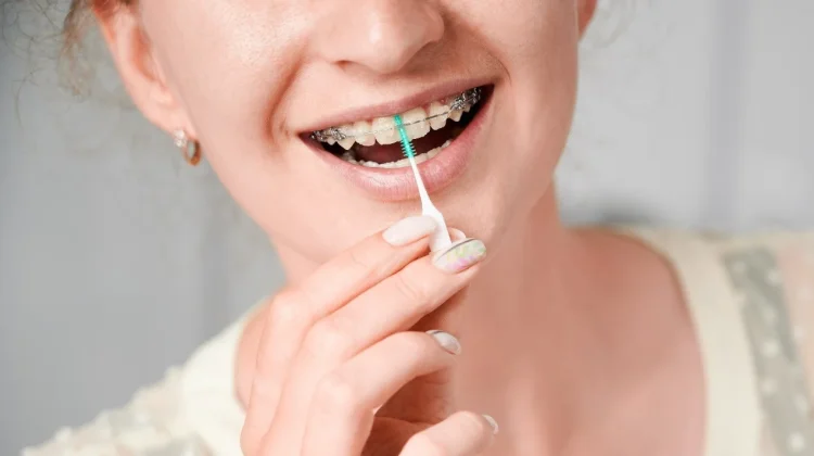 Interdental Brush, Alat Kecil Penyelamat Pengguna Behel
