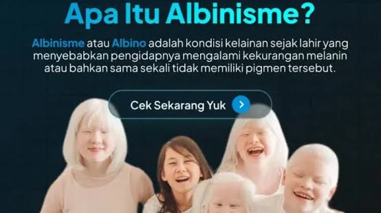 Albinisme bukan Penyakit Menular