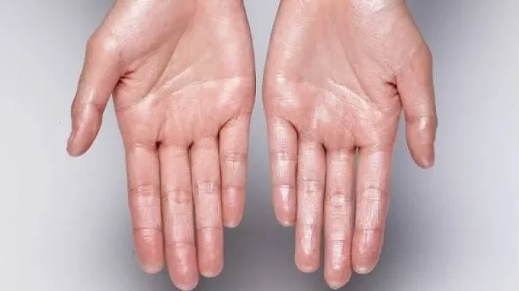 Penyebab serta Cara MengatasiTelapak Tangan dan Kaki Sering Berkeringat
