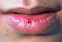 Tips Melembapkan Bibir saat Berpuasa