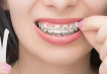 Atasi Sariawan karena Behel dengan Ortho Wax