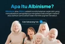 Albinisme bukan Penyakit Menular