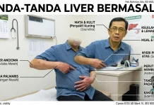Perlunya Peduli Gejala Liver Bermasalah Lebih Awal
