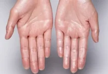 Penyebab serta Cara MengatasiTelapak Tangan dan Kaki Sering Berkeringat