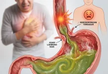 Sepuluh Kebiasaan Buruk yang Dapat Memicu Asam Lambung Naik