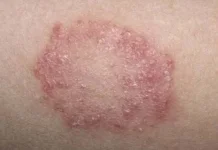 Infeksi Jamur Sebabkan Selangkangan Gatal dan Menghitam