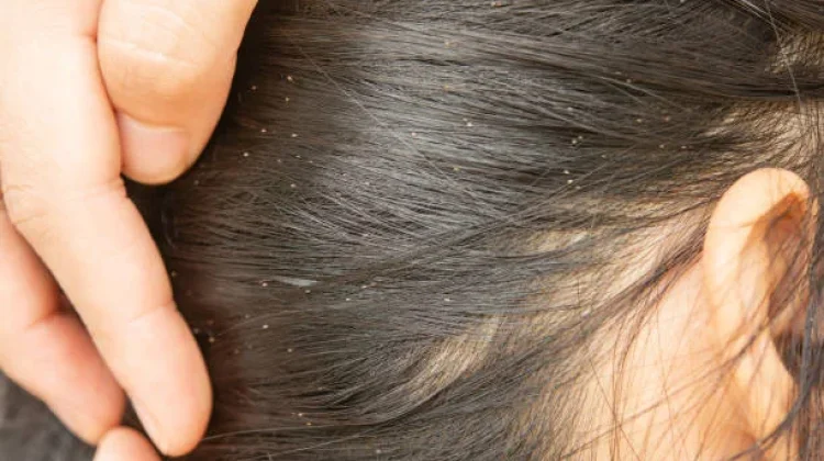 Cara Membasmi Kutu Rambut